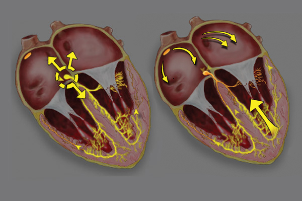 ECG - III